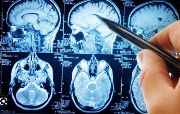 6 Orang yang Lebih Berisiko Alami Pendarahan di Selaput Otak