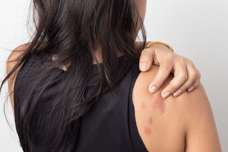 Apakah Sama, Biduran Dengan Alergi