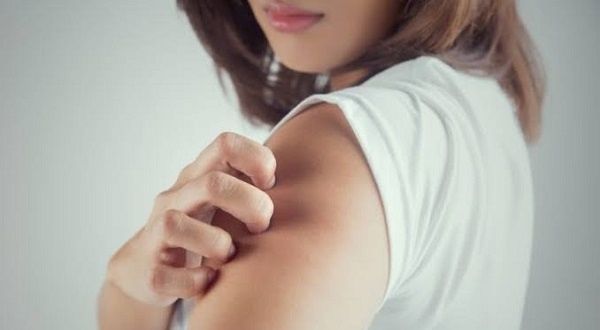 Ini Cara Ampuh Mengobati Biduran agar Gatal-gatal Tidak Kambuh