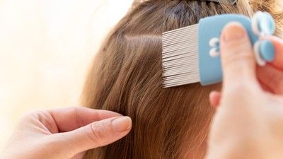 Ini Cara Menghilangkan Kutu Rambut beserta Telurnya