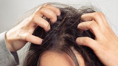7 Cara Menghilangkan Gatal pada Kulit Kepala