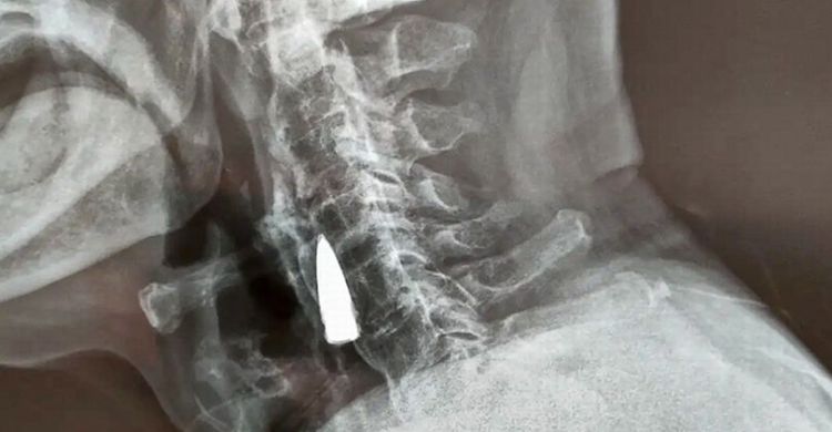 Gile, 77 Tahun Peluru Bersarang Di Leher